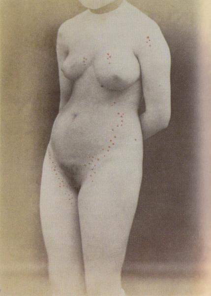 Image 6 - A. de Montméja, « <em>Syphilide vésiculeuse</em> », 1868.